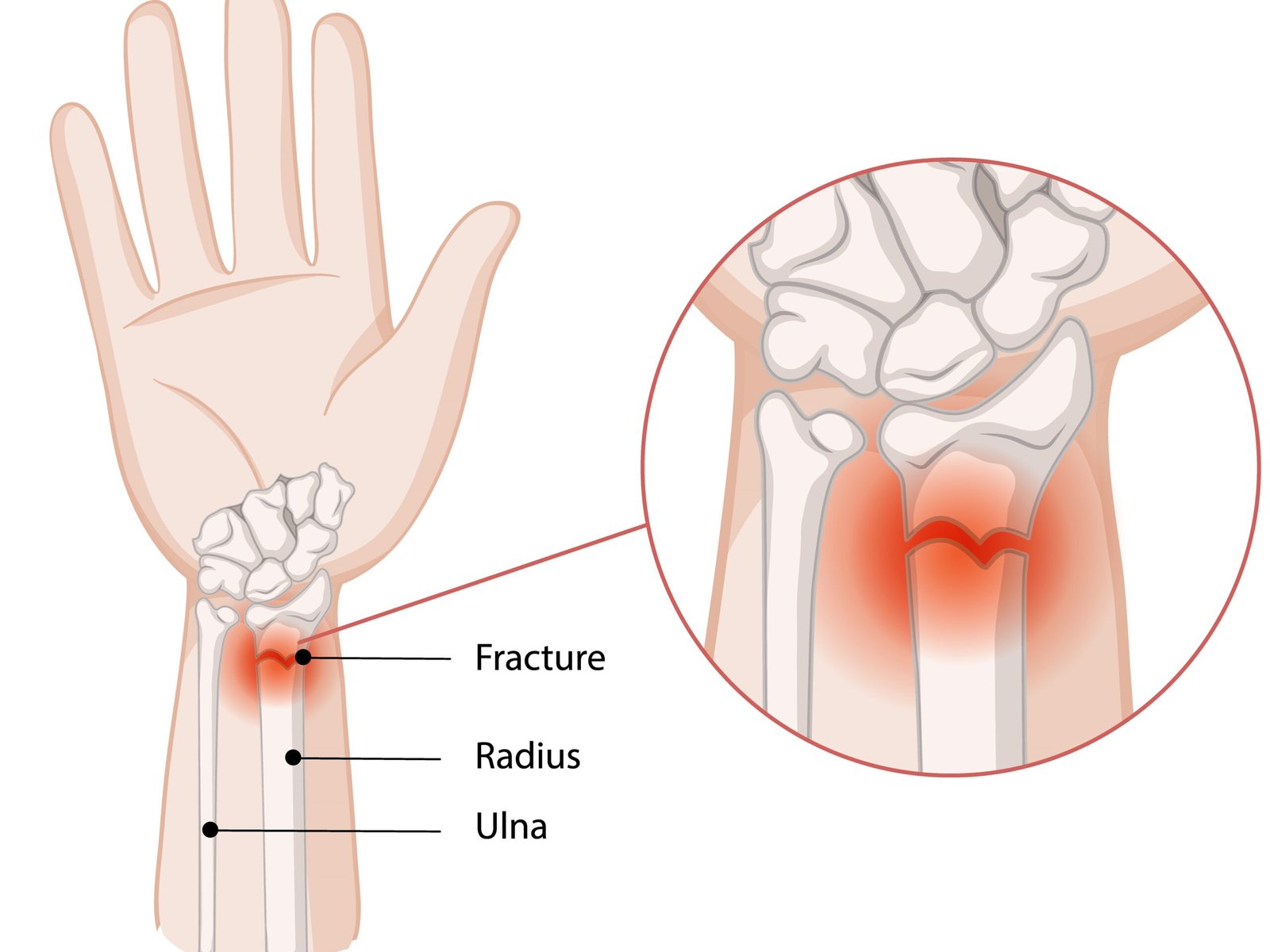 Illustration of wrist fractures and affected bones