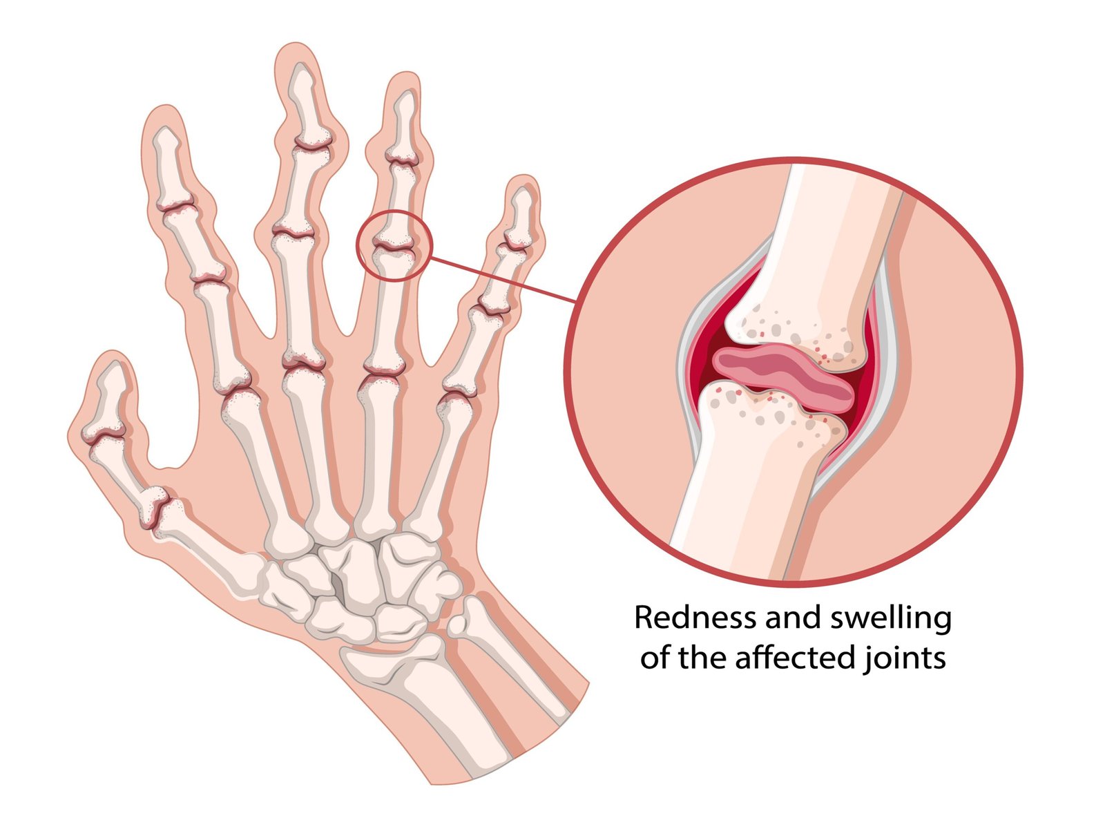 Degenerative joint disease affecting hand and wrist joints